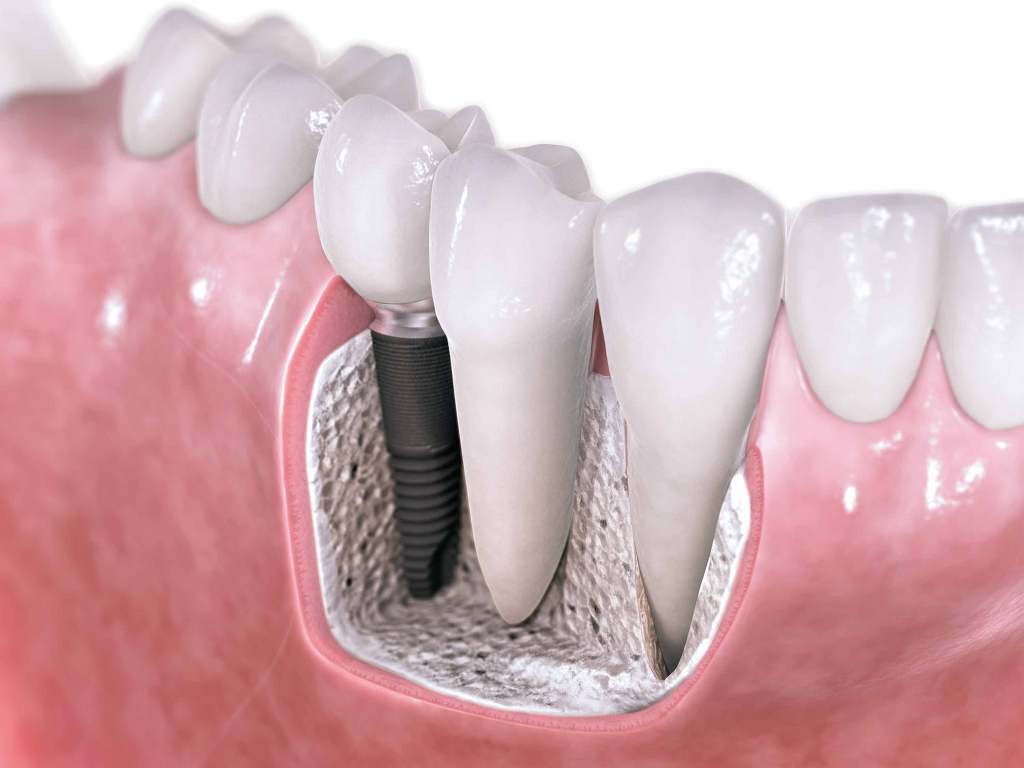 Dental-Implant-​Endosteal