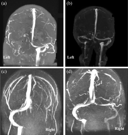 Brain-magnetic-resonance-venography