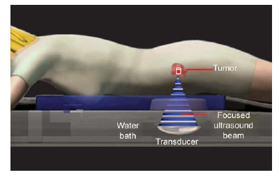 Magnetic-Resonace-Guided-Focused-Ultrasound