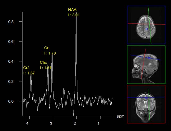 Magnetic-Resonance-Spectroscopy