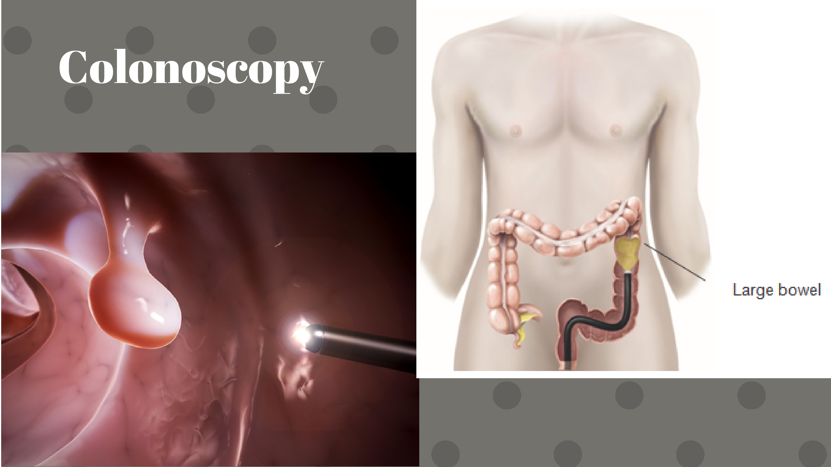 CANCER-Colonoscopy