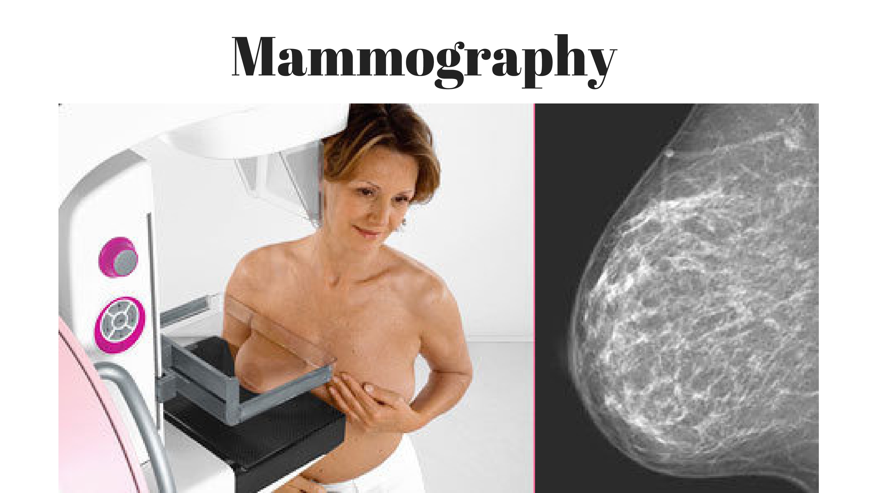 CANCER-Mammography