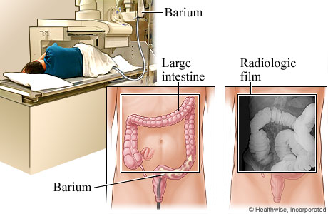 Cancer-Barium-Enema