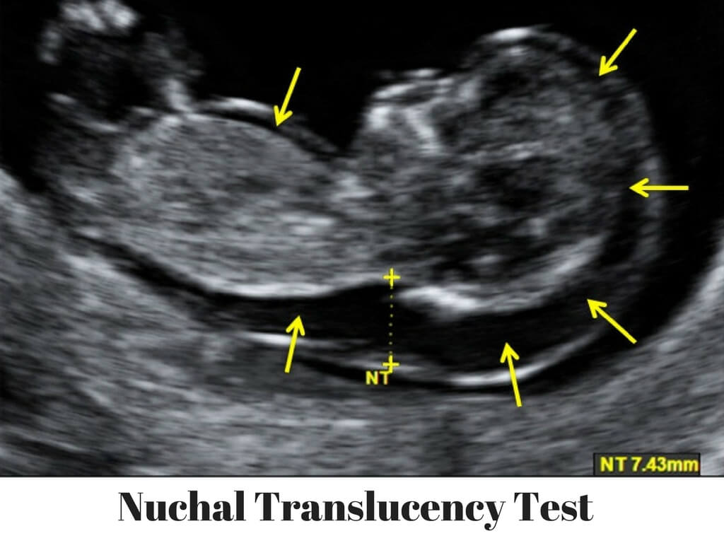 Nuchal-Translucency-Test