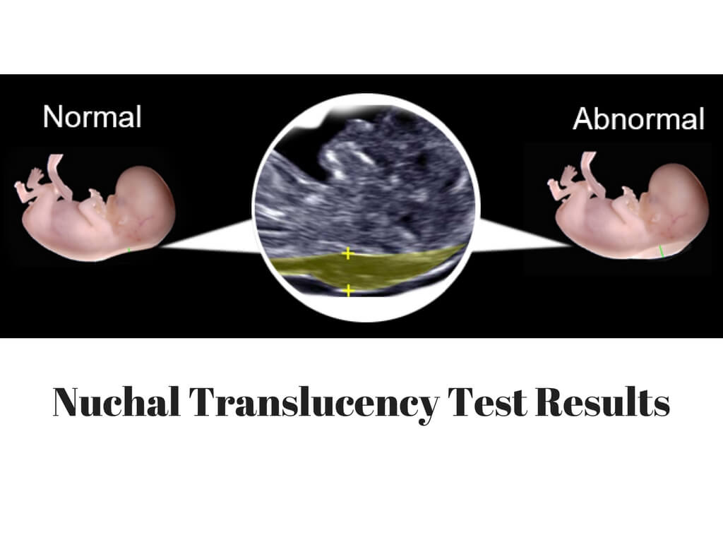 Nuchal-Translucency-Test-Results