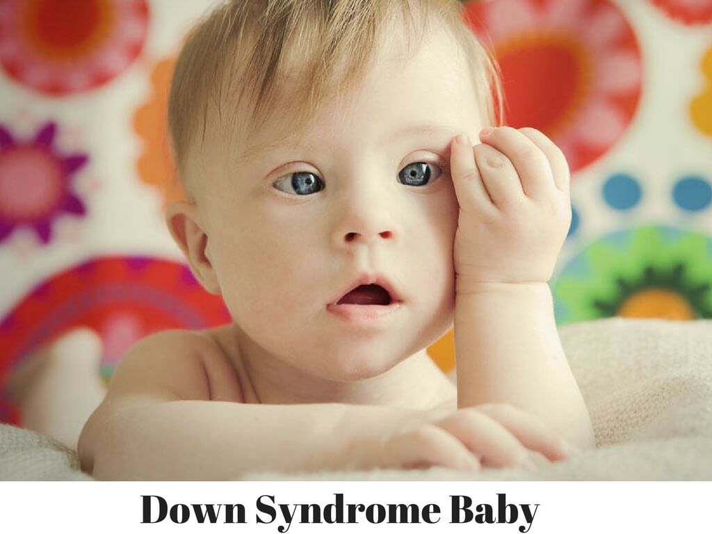 Down-Syndrome-Baby