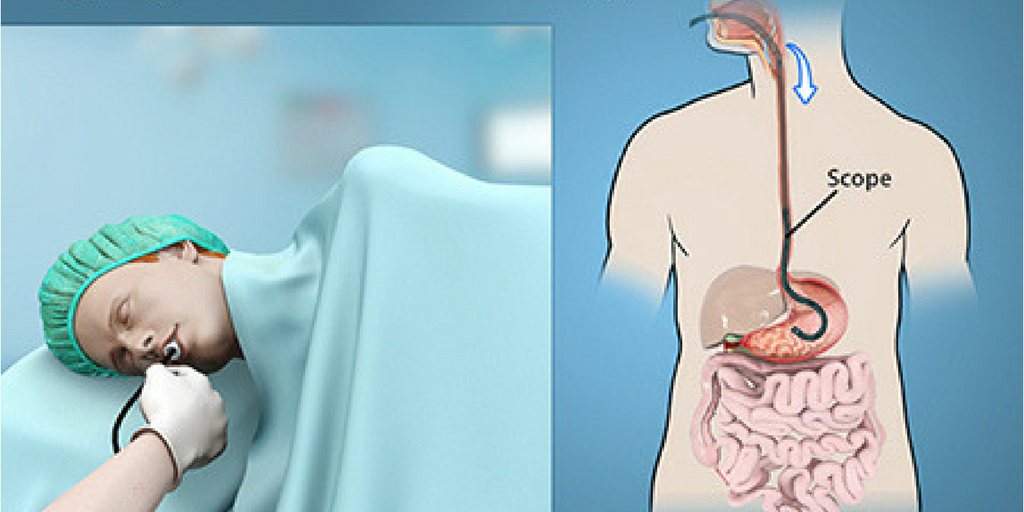 Cancer-Endoscopy