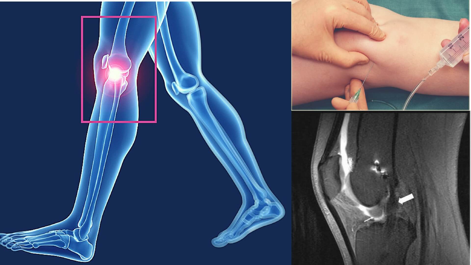 Arthrogram