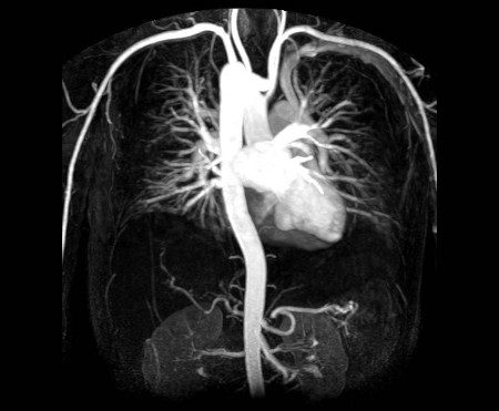 mri-angiogram-test