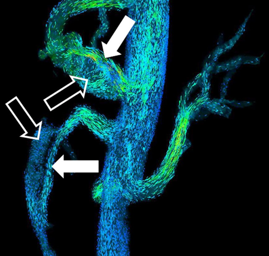 Angiogram