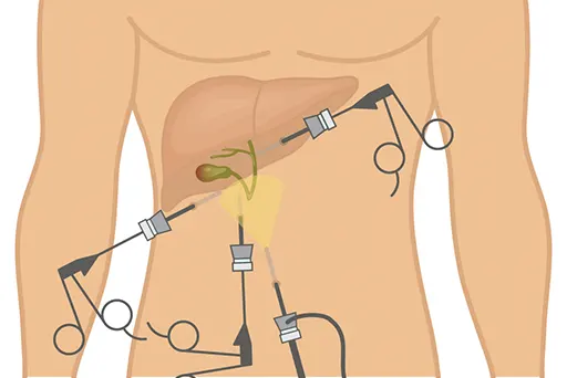 Gallbladder Removal Surgery