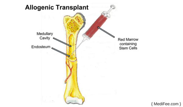 Allogenic Bone Marrow Transplant