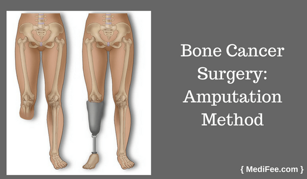 bone cancer amputation surgery method