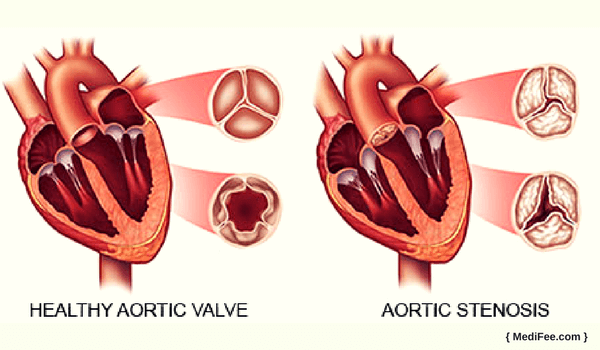 aortic stenosis