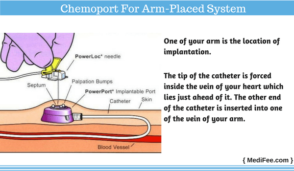 what is arm placed system in chemoport