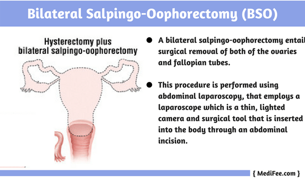 bilateral salpingo oophorectomy