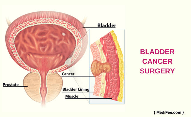 bladder cancer