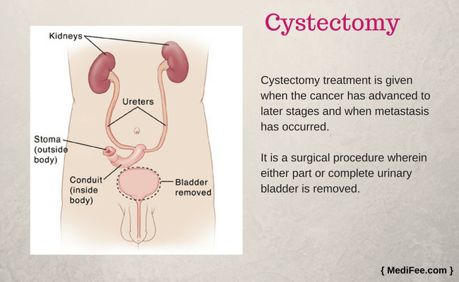 cystectomy