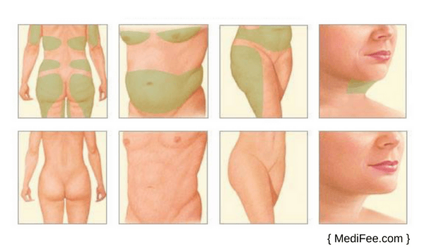 Full Body Contouring Surgery in India