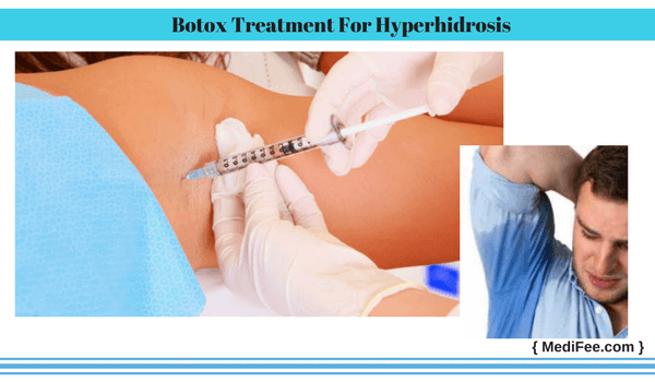 Botox Treatment For Hyperhidrosis