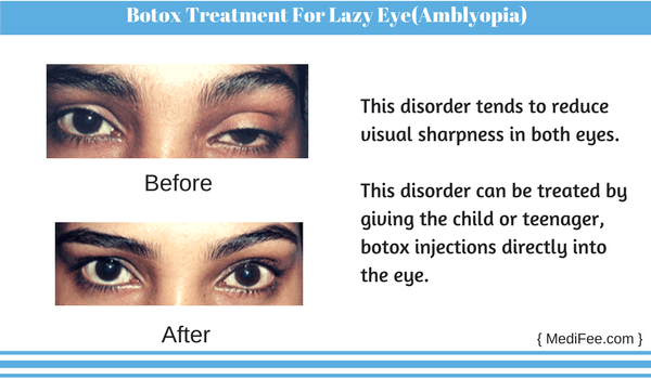 Botox Treatment For Lazy Eye(Amblyopia)