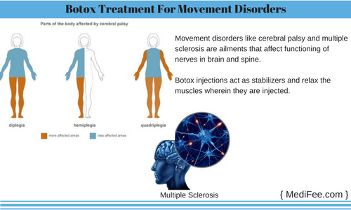 botox treatment movement disorder