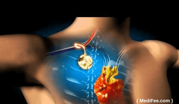 Port Placement Procedure Steps