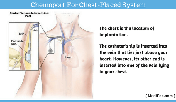 What is Chemoport Insertion and Placement Procedure?