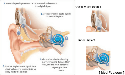 what is cochlear implant surgery what is cochlear implant