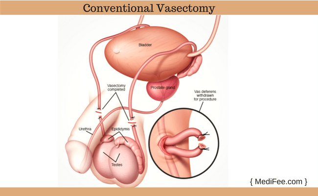 conventional vasectomy conventional vasectomy procedure