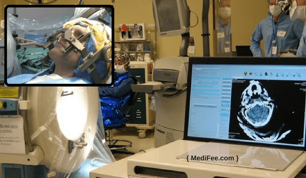 deep brain stimulation