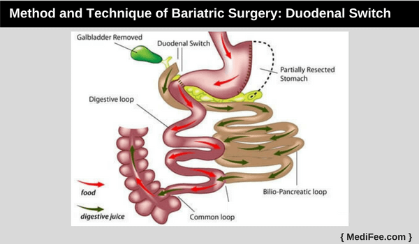 Duodenal Switch Duodenal Switch