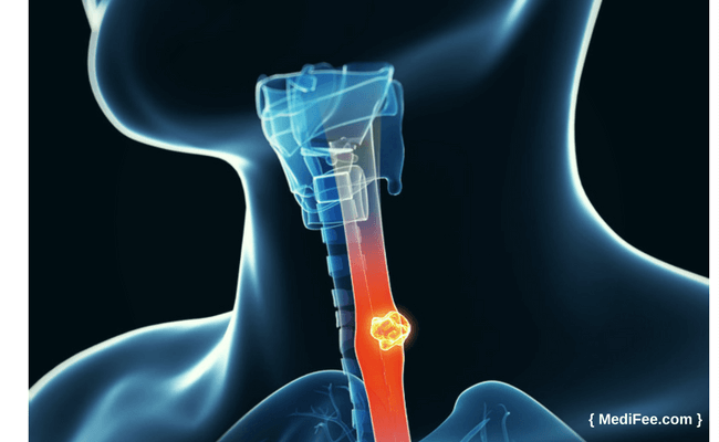 cancer of esophagus esophageal cancer