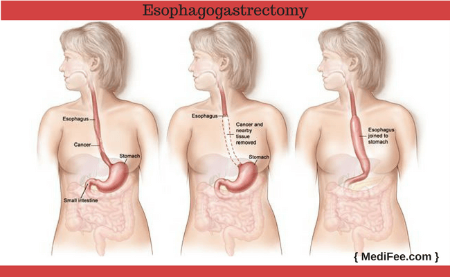 esophagogastrectomy procedure