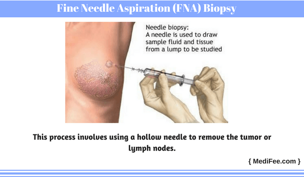 Fine Needle Aspiration (FNA) Biopsy