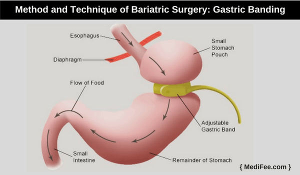 gastric banding gastric banding