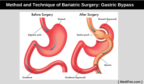 Gastric Bypass Gastric Bypass