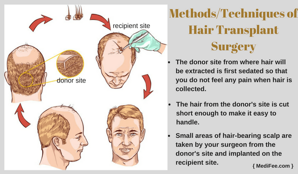 Hair Transplant: Surgery to Cure Baldness
