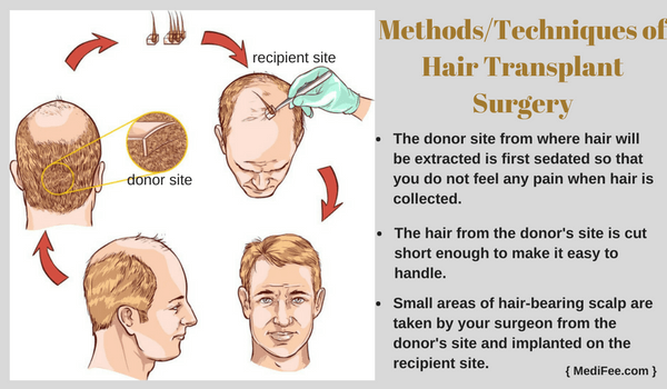 Hair Transplant: Surgery to Cure Baldness Hair Transplant: Surgery to Cure Baldness