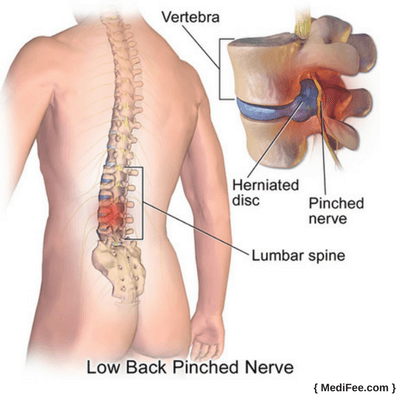 herniated disc