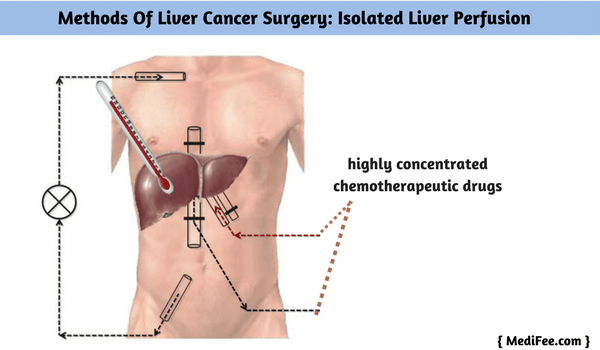 isolated liver perfusion