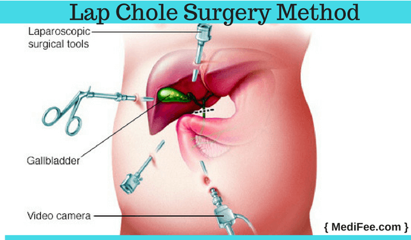 lap chole surgery method