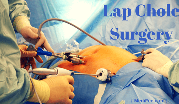 lap chole surgery