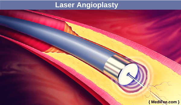 laser angioplasty