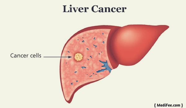 liver cancer