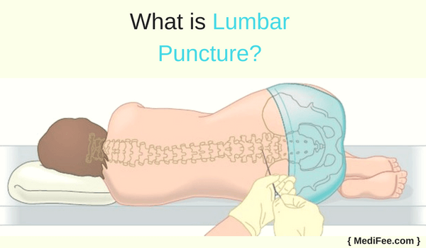 lumbar puncture