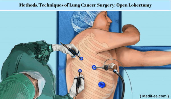 Lung Cancer Surgery Open Labectomy