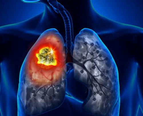 Lung Cancer Surgery