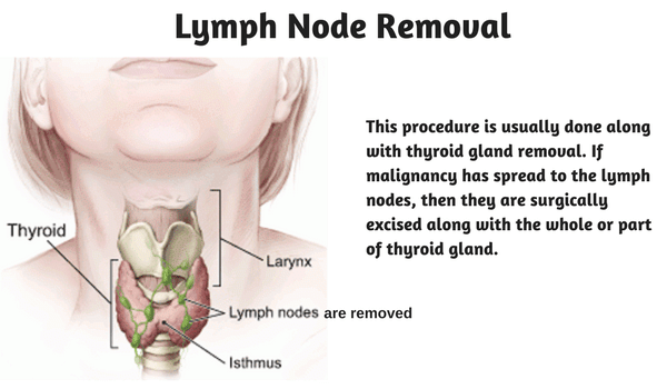 lymph node removal