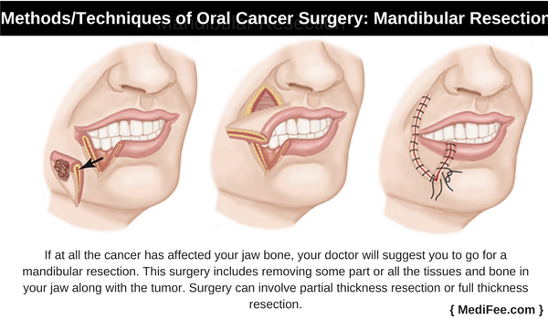 mandibular resection